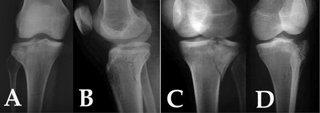 FRATURAS DO PLANALTO TIBIAL 469 seu diagnóstico firmado semanas após um quadro de dor persistente no joelho não responsivo às medidas clínicas habituais.