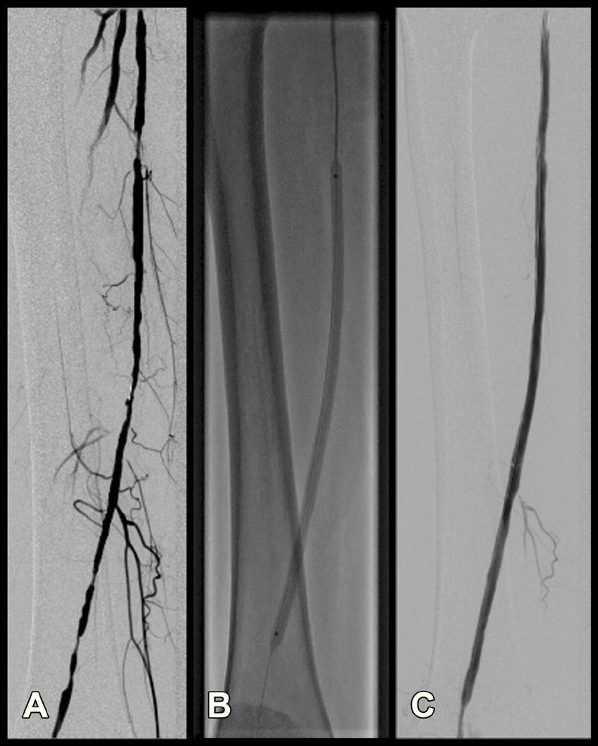 1 Em torno de 40% desses procedimentos são realizados no segmento femoral.