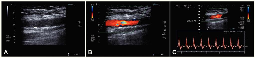 222 P. Metzger et al. / Rev Bras Cardiol Invasiva. 2015;23(3):220-225 Figura 3. Ultrassonografia vascular com Doppler. Em A, avaliação do stent em modo B. Em B, avaliação do fluxo em modo color.