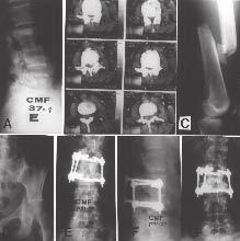 FIXAÇÃO MONOSSEGMENTAR DAS FRATURAS DA COLUNA TORACOLOMBAR Fig. 6 ARS, masculino, 30 anos. Fratura L1 Frankel E. A) Radiografia pré-operatória em perfil.