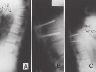 7 PHC, masculino, 21 anos. Luxação T11-T12 Frankel E. A) Radiografia pré-operatória em perfil. B) Controle radiográfico em perfil, após a fixação monossegmentar posterior e enxertia póstero-lateral.