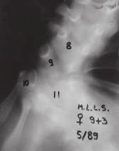 paraparesis impairing gait in May 1989 by congenital kyphoscoliosis 5 6 Fig.