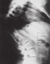5 and 6 Radiographs in post-surgical follow-up of nine years and nine months.