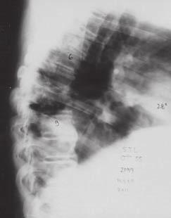 Fig. 8 Mielotomografia de fevereiro de 1997, ilustrando o local da descompressão e costotransversectomia Fig.