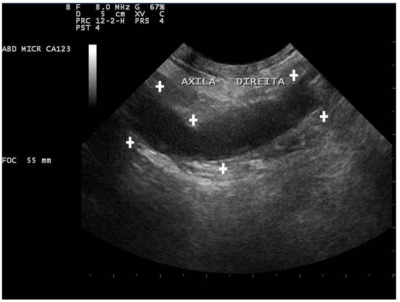 INTRODUÇÃO As neoplasias primárias dos nervos periféricos são infrequentes nos animais domésticos e são representadas, principalmente pelas neoplasias da bainha de mielina [1,2,13].