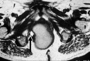 O foco de hiperintensidade em T1 é completamente suprimido nesta ponderação (seta). quístico com nódulo parietal, com foco de gordura e uma pequena calcificação adjacente.