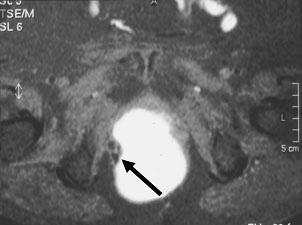 Após a administração de contaste paramagnético por via endovenosa, observou-se realce intenso da parede e do nódulo sólido, sendo este aspecto sugestivo de malignidade (Fig. 2).