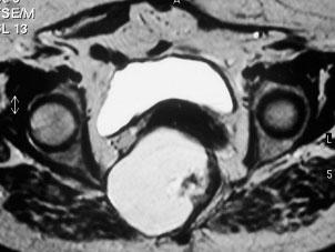 A doente foi submetida a cirurgia, por abordagem perineal, com ressecção completa do tumor e do cóccix.