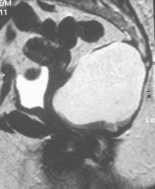 A análise microscópica do tumor revelou tratar-se de Teratoma com malignização do componente epitelial em adenocarcinoma (Fig. 4).
