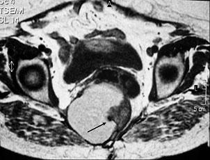 Fig. 3b Superfície externa do tumor. Fig.