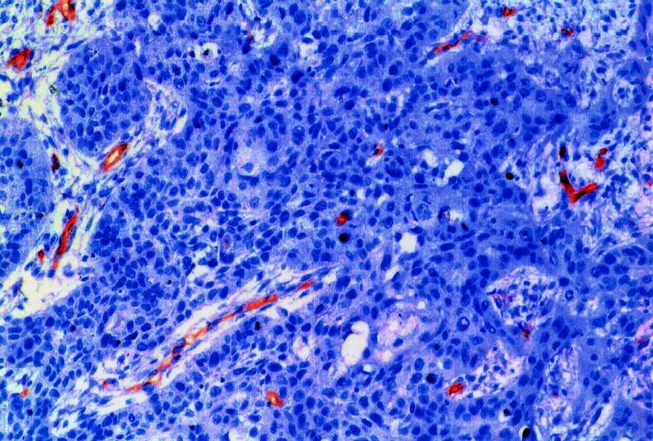 DENSIDADE MICROVASCULAR NO CARCINOMA DE LÍNGUA incubação com o anticorpo secundário e terciário do complexo streptavidinabiotina, kit LSAB (DAKO número KO 690) durante minutos, revelados pela