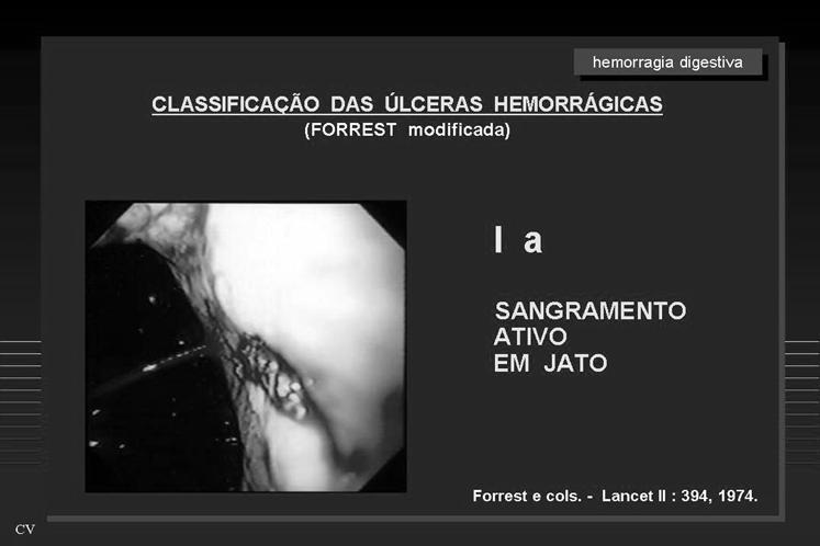 plasma sangue 7 endoscopia digestiva alta É sem dúvida o melhor método diagnóstico etiológico para HDA: localização calibre sinais de