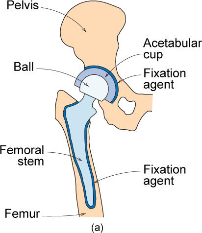 Exemplo Implante