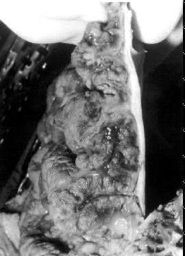 Doença de Ménétrier Cheinquer et al. ruptura de pequenos cistos. O aspecto histopatológico era sugestivo de doença de Ménétrier. A pesquisa de H. pylori foi negativa.