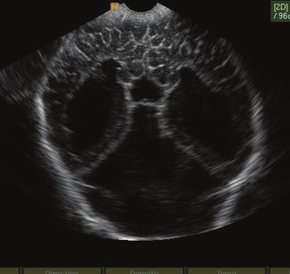 Figura 8: USG transfontanelar.