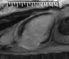 Figura 3. Imagens de RMC evidenciando o realce tardio após injecção de contraste gadolíneo.
