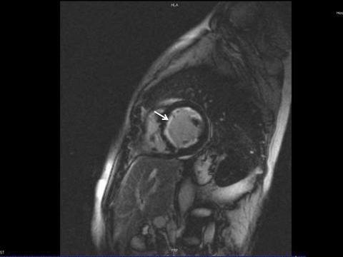 Destaca-se a importância do uso de contraste gadolíneo para o estudo de realce tardio na avaliação da precisa localização e extensão do processo fibroso no endocárdio.