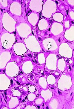 Tecido Adiposo Unilocular - células grandes, esféricas, contêm uma