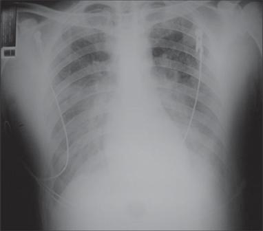 Radiograma de tórax quando da retirada do CPAP DISCUSSÃO A SPCVH é uma zoonose que pode evoluir de forma fulminante em seres humanos, com um quadro clínico de insuficiência respiratória por edema