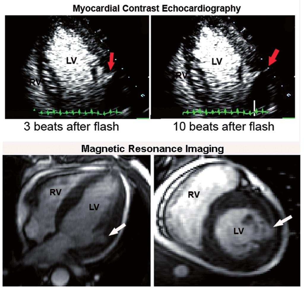 a detecção de complicações do IAM pela ecocardiografia bidimensional, como ruptura miocárdica e formação de pseudo-aneurismas, tem sido facilitada com o uso de contraste, como ilustrado na figura 210.
