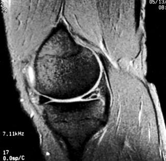 Erros comuns de interpretação de ressonância magnética de joelho que não se estendem à superfície articular.