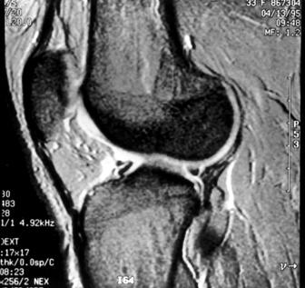 O tendão e a sua bainha são estruturas intra-articulares que se interpõem entre o menisco, a cápsula articular e o ligamento colateral lateral (13).