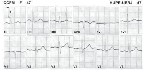 40 Vol 19 N o 1 Figura 6 ECG e VCG normal de uma paciente de 47 anos de idade.