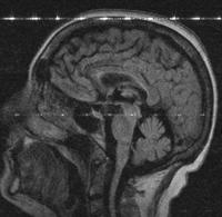 não-nula nula Ecitação: Usa-se se um gradiente perpendicular ao plano do corte (G( z ) Aplica-se um pulso de RF (campo B 1 ) tunado na freqüência dos spins que se deseja ecitar A magnetização dos