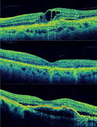 Prevalência de Adesão Vitreo-Macular Focal na Degenerescência Macular Ligada à Idade Exsudativa Pretendeu-se, neste estudo, determinar a prevalência de adesão vitreo-macular focal numa amostra de