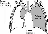 esvaziadora Empiema Pneumotórax Derrame constituído de