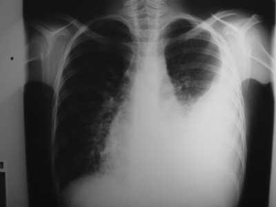 Hemotórax É a presença de sangue na cavidade pleural resultante de lesões do parênquima pulmonar, de vasos da parede torácica ou de grandes vasos como aorta, artéria subclávia, artéria pulmonar ou
