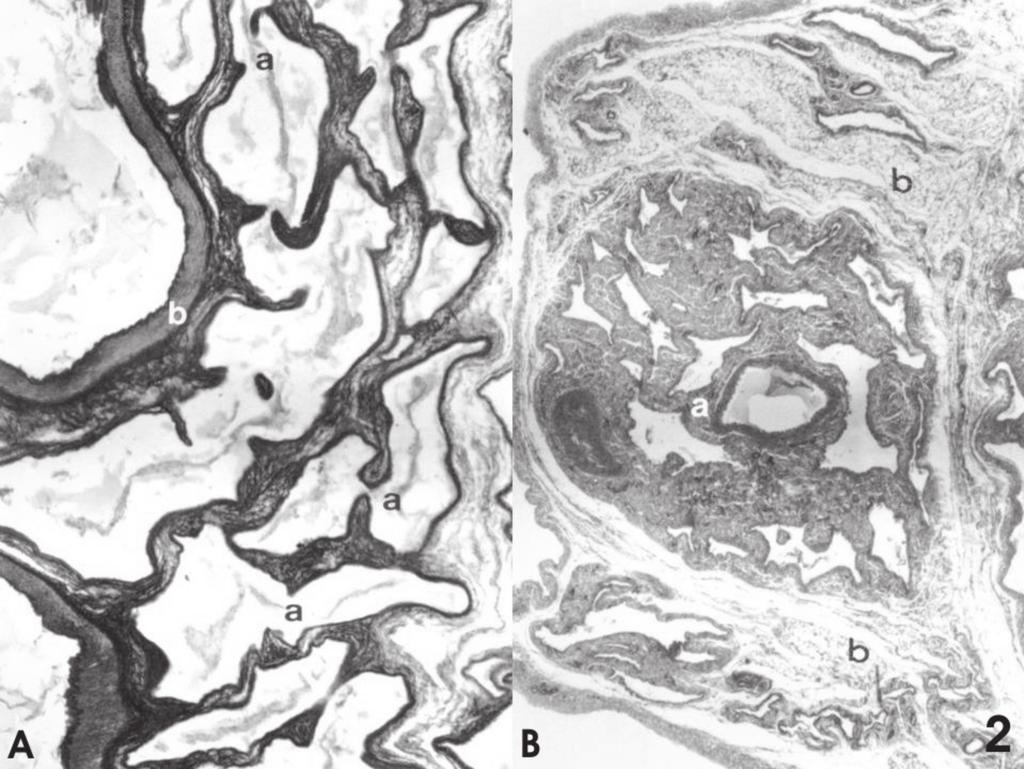 714 Luis A.O. P. Costa et al. Fig.2. (A) Complexo venoso do funículo espermático. Intercomunicação das veias testiculares (a) circundando a artéria testicular (b). Orceína Nítrica, 30x.