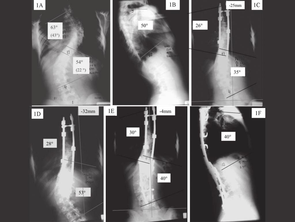Figura 1 Paciente de 13 anos, sexo feminino.: 1A/1B: RX iniciais; 1C: RX pós-operatorios; 1D: RX com 1 ano. 1E/1F: RX do final do acompanhamento.
