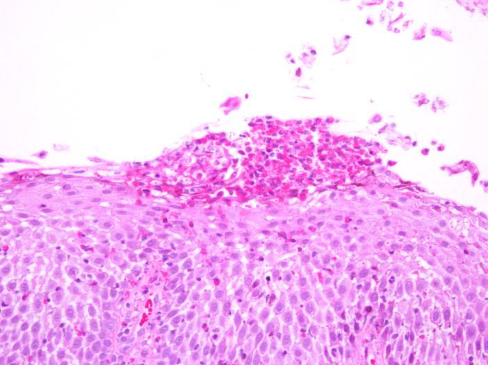 (Fonte: produção do próprio autor) Figura 4 - Fotomicrografia de microabscesso de eosinófilos no