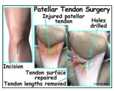 - somente para lesões parciais do ligamento patelar; - lesões parciais podem ser tratadas com imobilização por 3-6 semanas; - lesões completas do ligamento patelar demandam reparo cirúrgico; - sutura