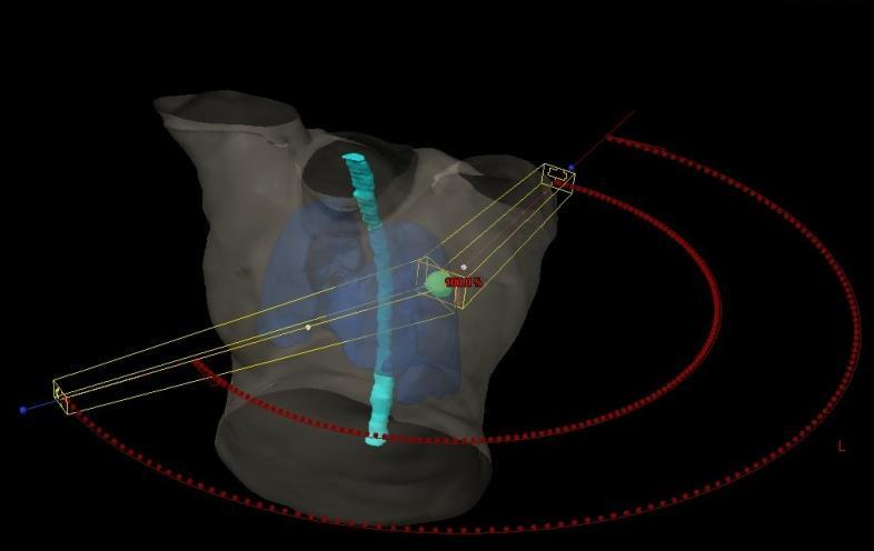 FIGURA 12. Planejamento de um SABR de pulmão com VMAT. A SABR está sendo testada no mundo todo devido às novas tecnologias existentes no mercado. Em alguns casos, ela pode substituir a cirurgia.