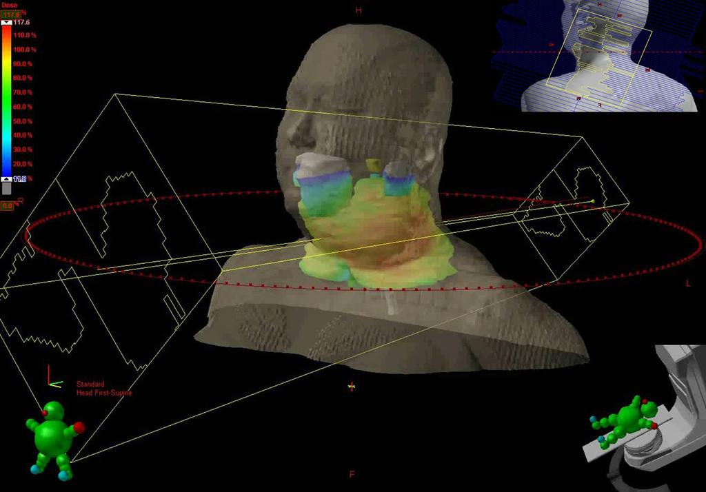 Radioterapia em Arco Modulado Volumétrico A Radioterapia em arco modulado volumétrico (VMAT) como o mostrado na reconstrução 3-D conforme a (FIG.