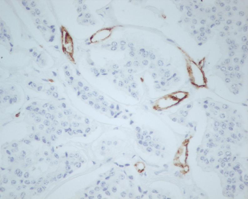 determinada pela expressão de CD31, foi de 13,0 /cga. Vasos Células tumorais Figura 3. Vasos com expressão de CD31 num tumor neuroendócrino (x400-0.15mm2).