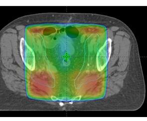 Radioterapia 2D: