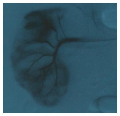 Fig. 3 Arteriografia realizada previamente à Embolização. Fig.