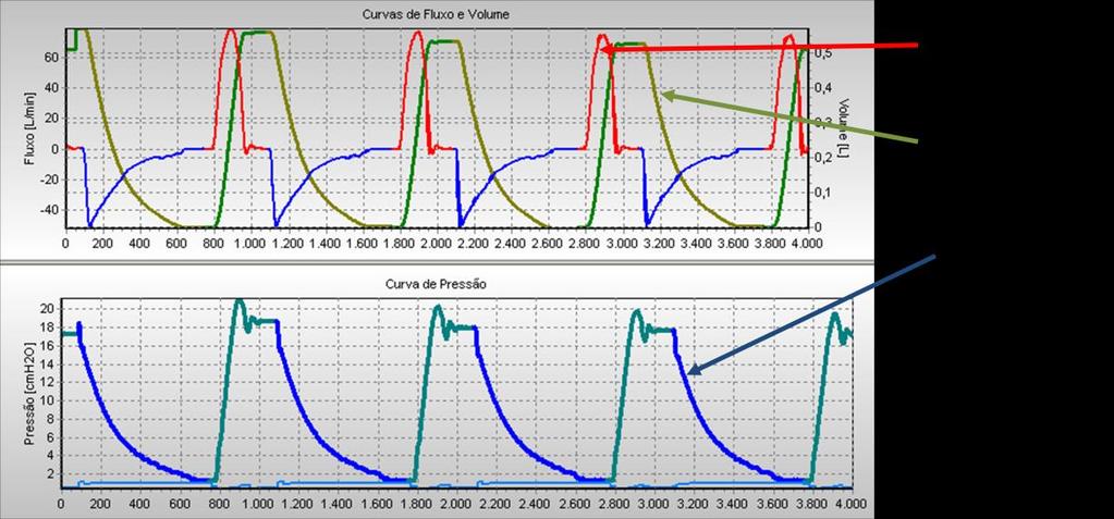 Projeto de Controladores para de Ventilação Mecânica Pulmonar Figura 378 VCV adulto com volume corrente de 500ml e curva senoidal. L.1.2.