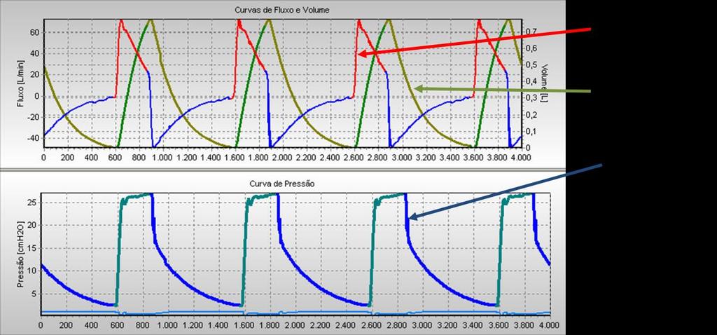 pressão limite de 17 e PEEP de 2 cmh 2 O.