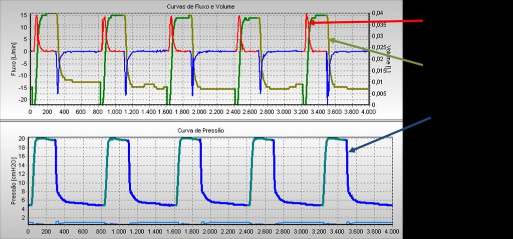 Rp200 e complacência de 0,5mL/cmH 2 O.