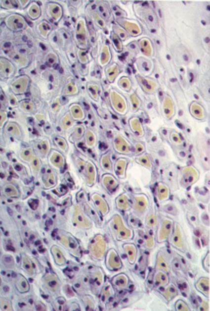 denso, Fonte: Cytology of the Female Genital Tract - OMS