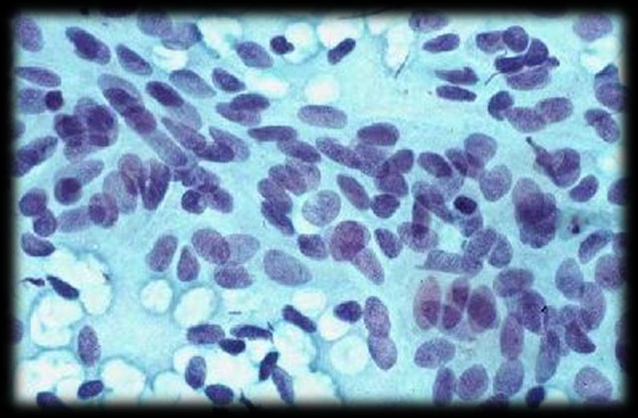 Notas explicativas: Este é um exemplo mais difícil de atrofia.