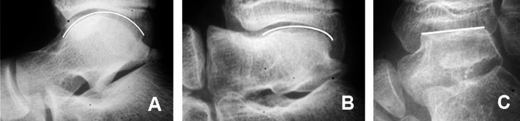Alterações radiográficas do tálus no pé torto congênito após liberação cirúrgica pela técnica de McKay 21 Tabela 1 Relação de pacientes envolvendo idade, sexo, lado acometido, data da cirurgia e data