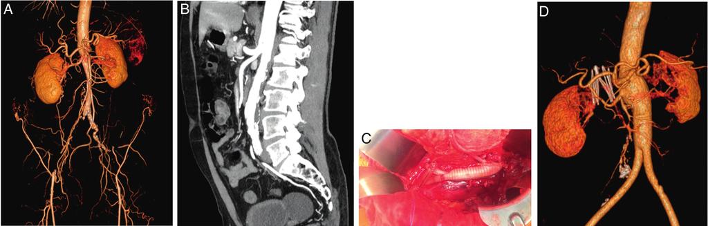 184 V. Manuel et al. da aorta torácica descendente, realizada sob clampagem total ou parcial da aorta.