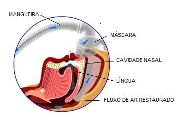 44 2.3 TRATAMENTO DA APNEIA DO SONO Pressão aérea positiva contínua (CPAP continuous positive airway pressure) é o padrão áureo para tratamento da apneia do sono.