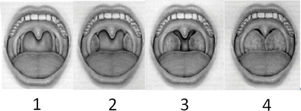 Introdução 21 distúrbios respiratórios do sono considerados, nos dias de hoje, a principal causa para realização de tonsilectomia (Erickson et al., 2009).