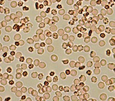 86 Na avaliação de hemólise dos eritrócitos por microscopia óptica (Figura 36), utilizando a mesma concentração e volume de células, foi